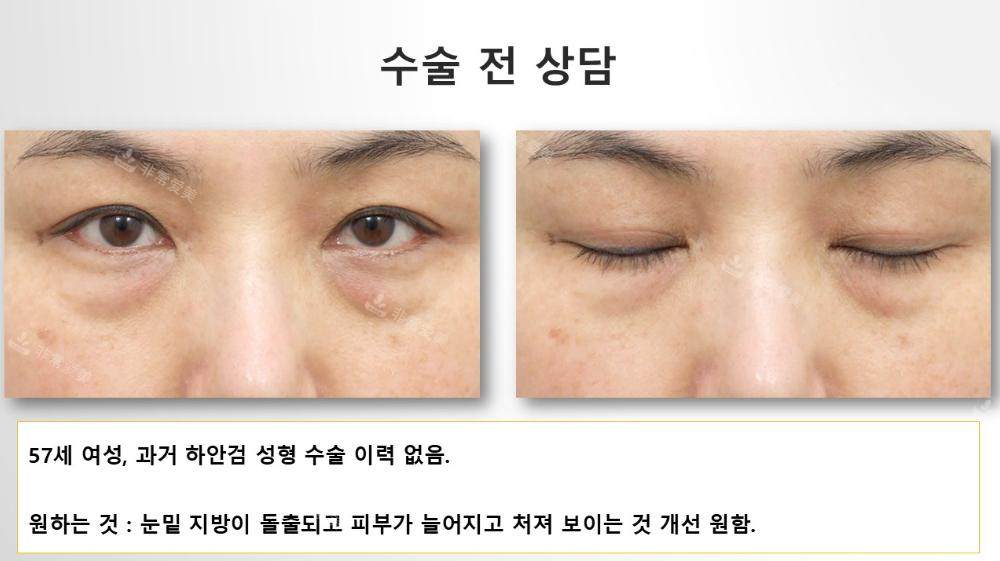 韩国Sone整形外科50岁女性眼下脂肪重排术，术后1年9个月状态依旧紧致