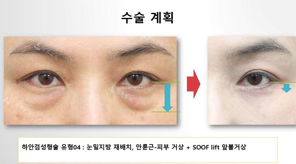 韩国Sone整形外科50岁女性眼下脂肪重排术，术后1年9个月状态依旧紧致