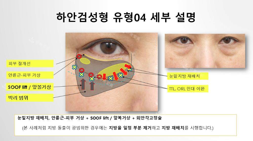 韩国Sone整形外科50岁女性眼下脂肪重排术，术后1年9个月状态依旧紧致