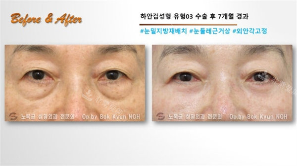 韩国Sone整形外科眼袋手术前