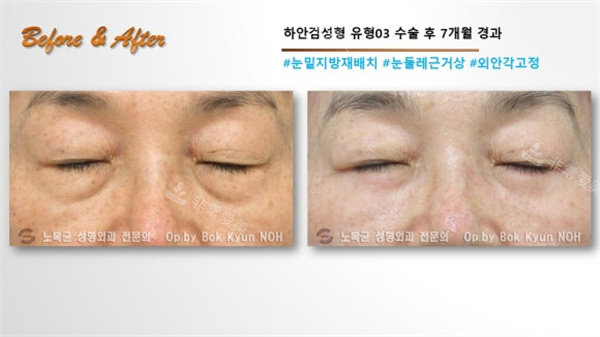 韩国Sone整形外科眼袋手术前闭眼