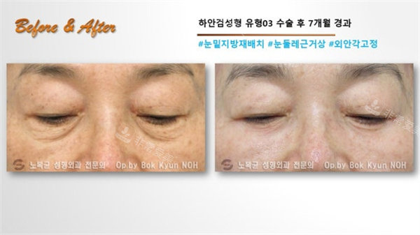 韩国Sone整形外科眼袋手术前俯视图