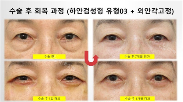 韩国Sone整形外科眼袋手术后对比