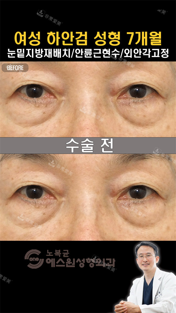 【韩国Sone整形外科熟...