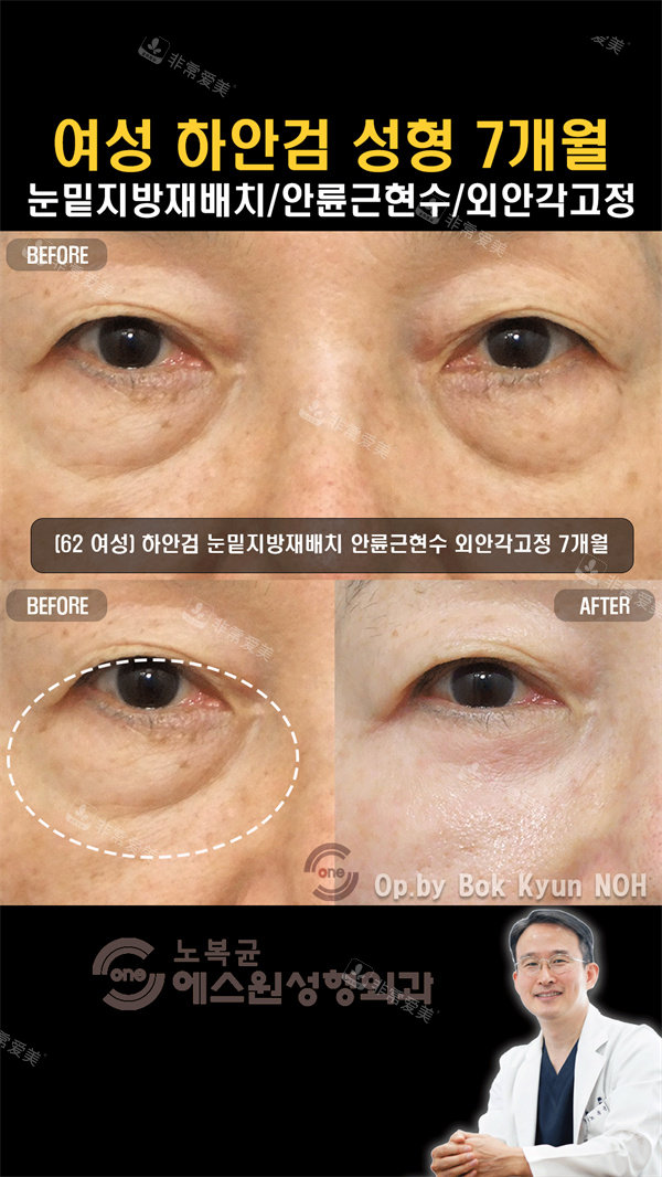 韩国Sone整形外科眼袋手术前后对比