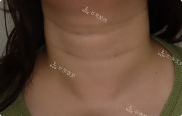 韩国爱丽儿整形外科颈纹实例前