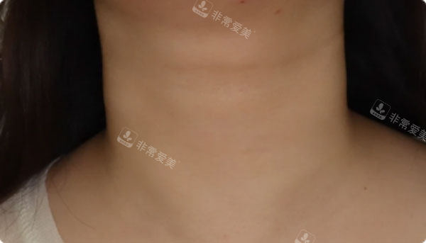 韩国爱丽儿整形外科颈纹实例后