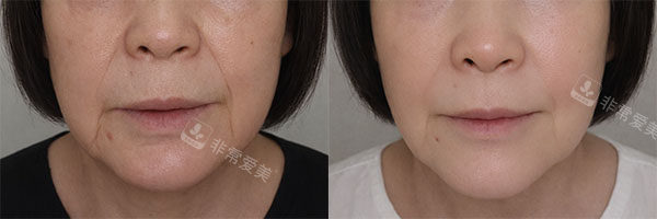 韩国爱丽儿整形外科面部填充改善八字纹对比照片