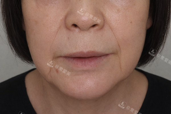 韩国爱丽儿整形外科面部填充改善八字纹术前照片