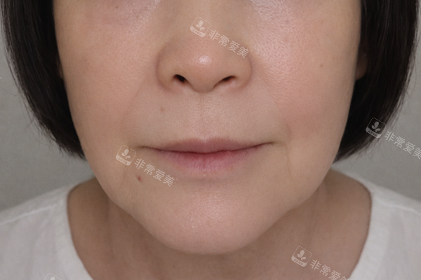 韩国爱丽儿整形外科面部填充改善八字纹术后照片