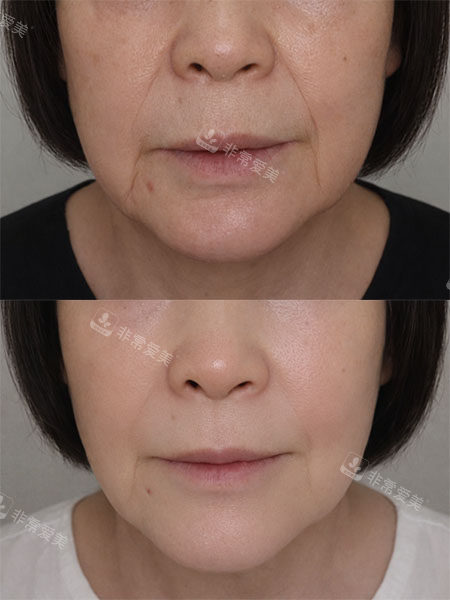 韩国爱丽儿整形外科面部填充改善八字纹前后对比照片