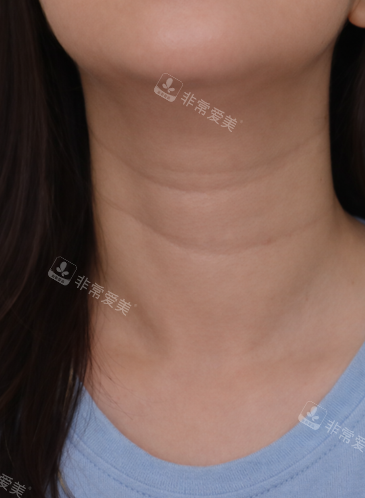 韩国爱丽儿整形外科颈纹改善病例前 韩国爱丽儿整形外科颈纹改善病例前