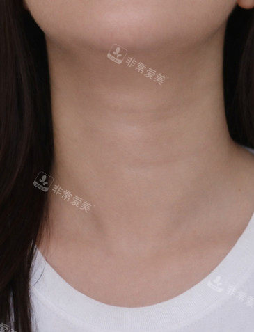 韩国爱丽儿整形外科颈纹改善病例后 韩国爱丽儿整形外科颈纹改善病例后