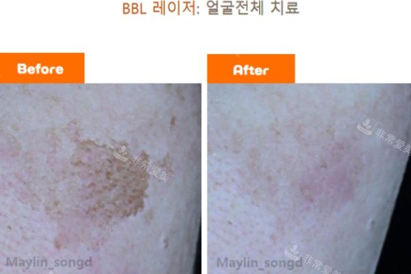 韩国仁川媄琳皮肤科反馈对比图