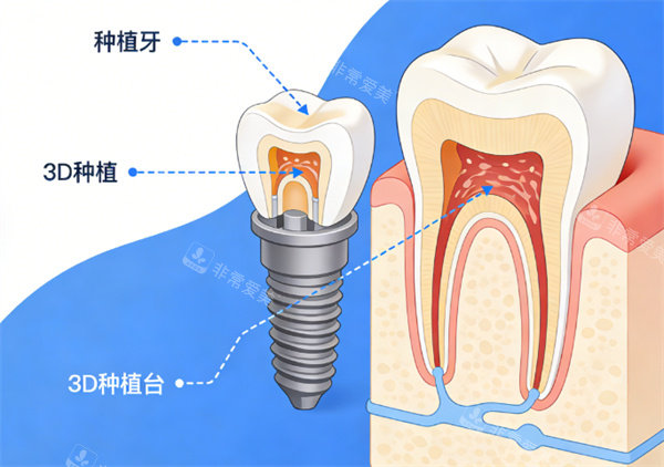 种植牙模型展示示意图