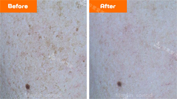 韓國仁川媄琳皮膚科祛斑前后對比圖 韓國仁川媄琳皮膚科祛斑前后對比圖