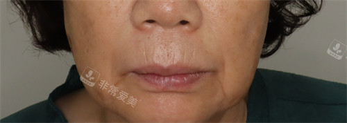 韓國愛麗兒整形怎么樣