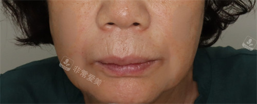 韓國愛麗兒整形實例展示