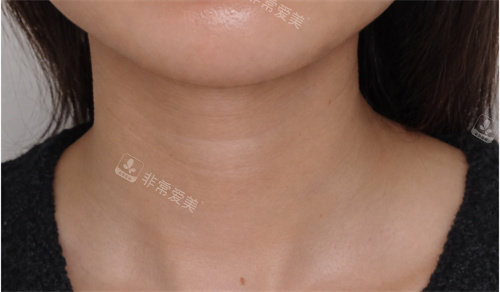 韓國(guó)愛(ài)麗兒整形去頸紋示例圖 韓國(guó)愛(ài)麗兒整形去頸紋示例圖