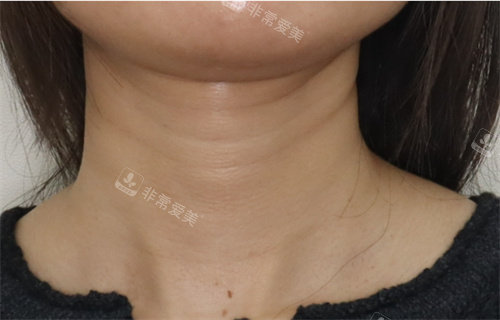 韓國(guó)愛(ài)麗兒整形去頸紋手術(shù)圖 韓國(guó)愛(ài)麗兒整形去頸紋手術(shù)圖