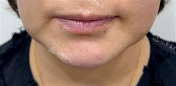 韓國greeny皮膚科唇部整形前