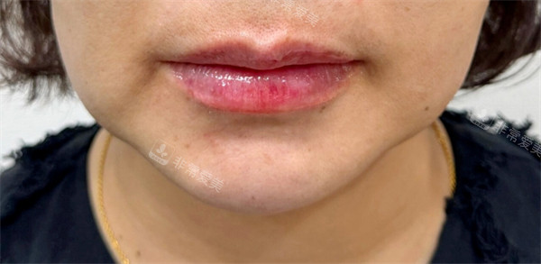 韓國greeny皮膚科唇部整形后