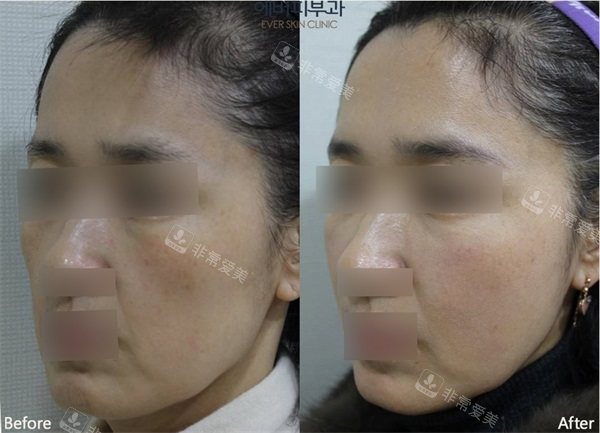 韓國ever皮膚科全臉填充物術(shù)前術(shù)后對比照片