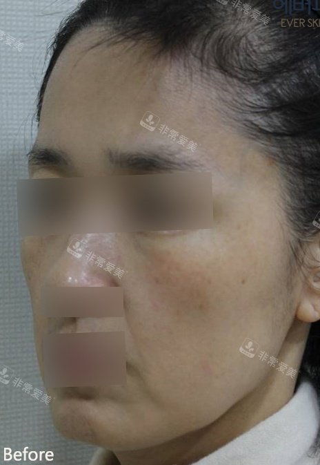 韓國ever皮膚科全臉填充物前后術(shù)前照片