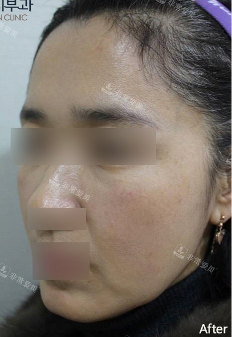 韓國ever皮膚科全臉填充物前后術(shù)后照片