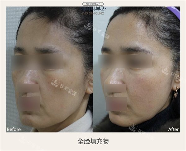 韓國ever皮膚科全臉填充物前后對比照片