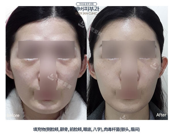 韓國ever皮膚科面部填充前后對比