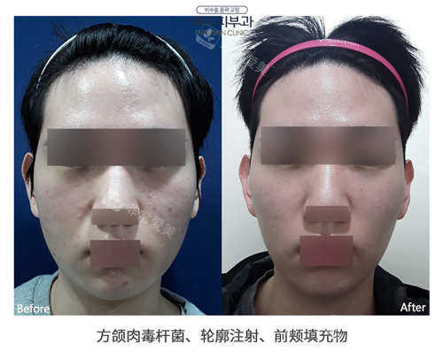 韓國(guó)EVER皮膚科男士聯(lián)合治療蛻變術(shù)例