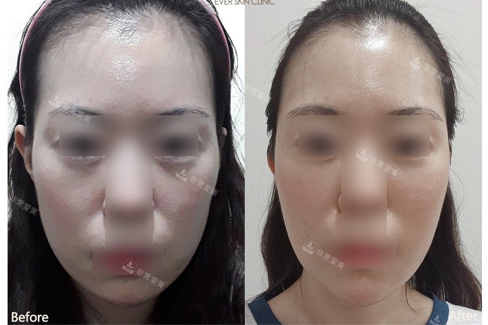 韓國ever皮膚科實例對比