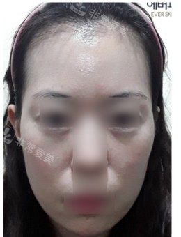EVER皮膚科改善前