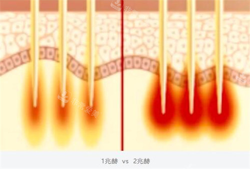 黑曜双波黄金微针双波发射模式