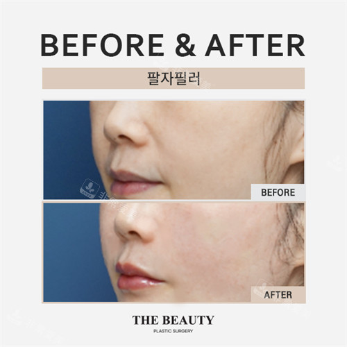 韩国the beauty整形外科&皮肤科鼻基底填充前后对比