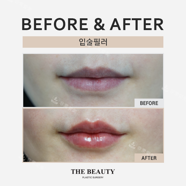 韩国the beauty整形外科&皮肤科对比实例