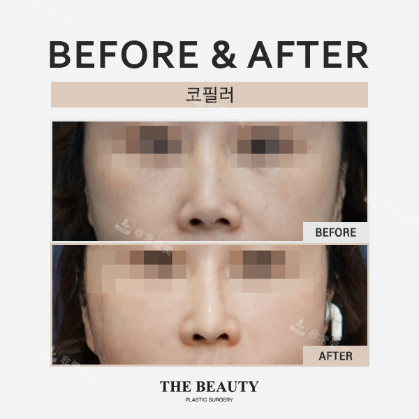 韩国the beauty整形外科法令纹填充前后对比