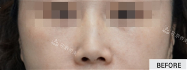 韩国the beauty整形外科法令纹填充前