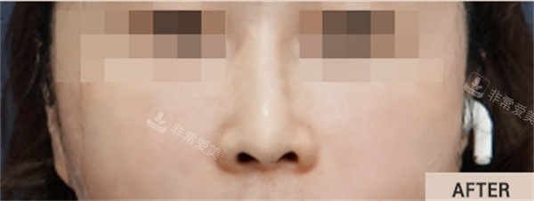 韩国the beauty整形外科法令纹填充后